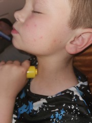 Spots of childs cheek