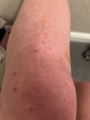 What is this rash?