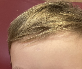 Large chicken pox scar