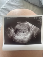 Fetal pole