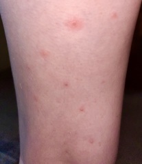 Is this Chicken Pox?