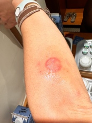 What is this? With pics. Eczema / Ringworm / psoriasis?