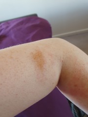 Skin stain after iron infusion