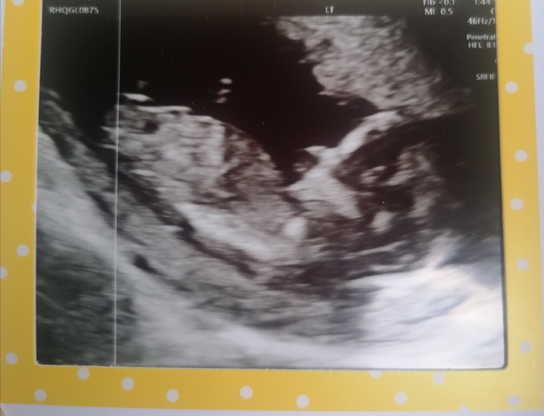 Opinion on 12 week scan - normal or am I stressing over nothing?