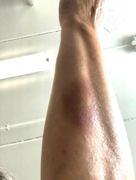 What has caused this bruise?