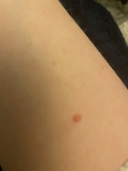 Positive stories about itchy mole - scared