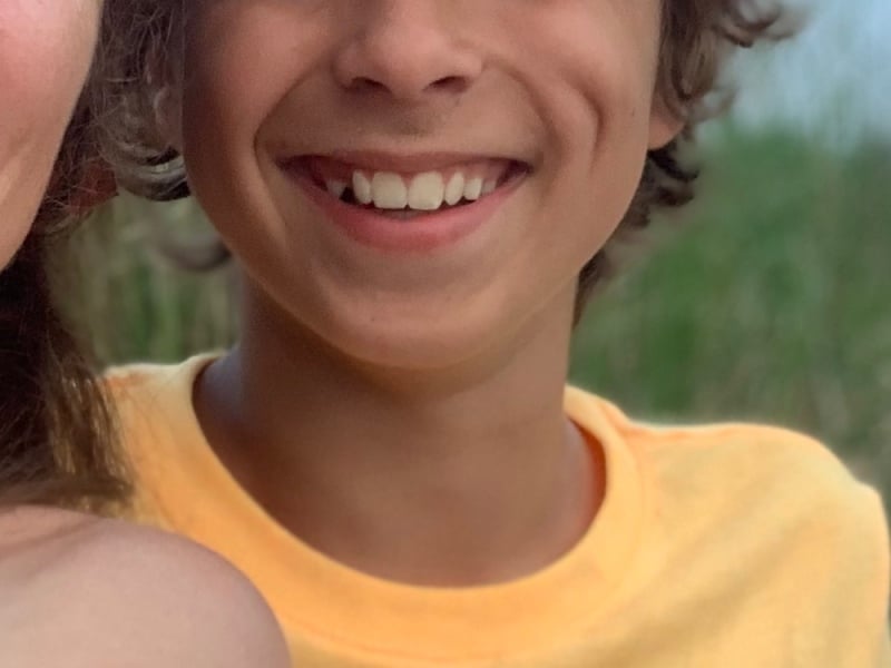 Dimple caused by cheek injury