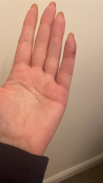 Does this look infected? Rat bite