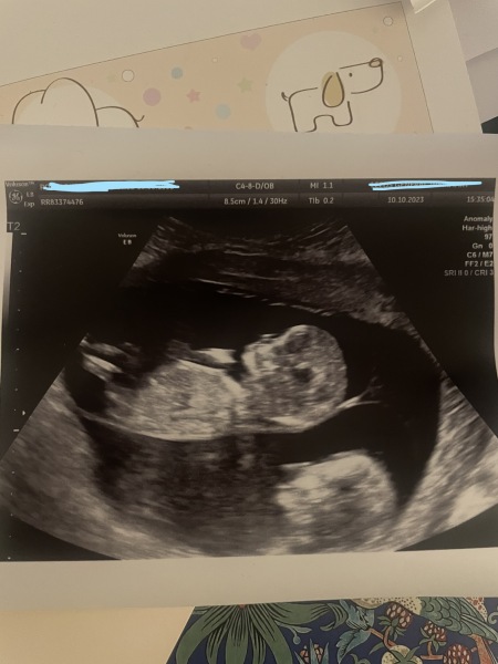Gender guesses identical twins
