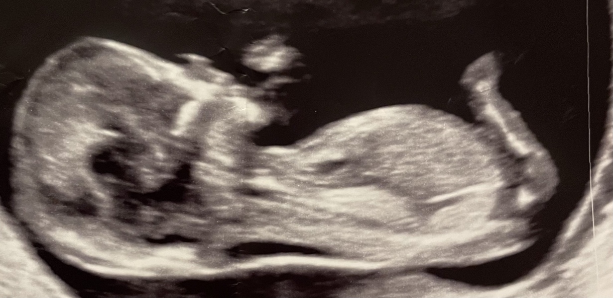 Nub theory boy or girl ? Interested to hear people’s thoughts