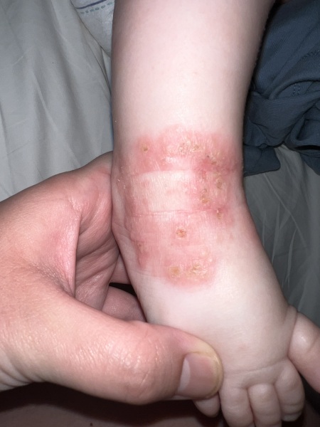 Please can anyone help ?! In hospital abroad with sick baby ( graphic pictures)