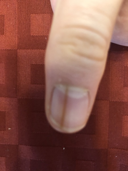 Aibu to go to GP about fingernail line?