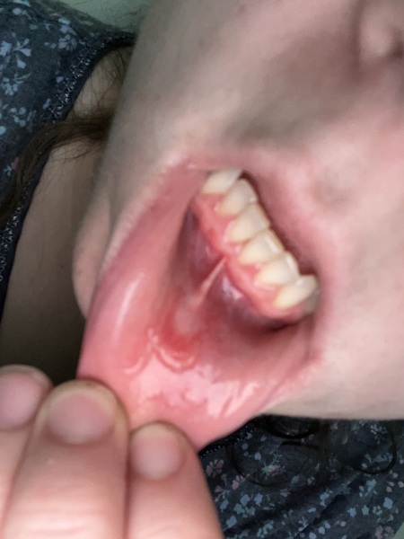 Inner lip ulcer or cancar sore?