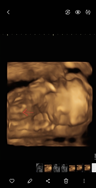 3d ultrasound help