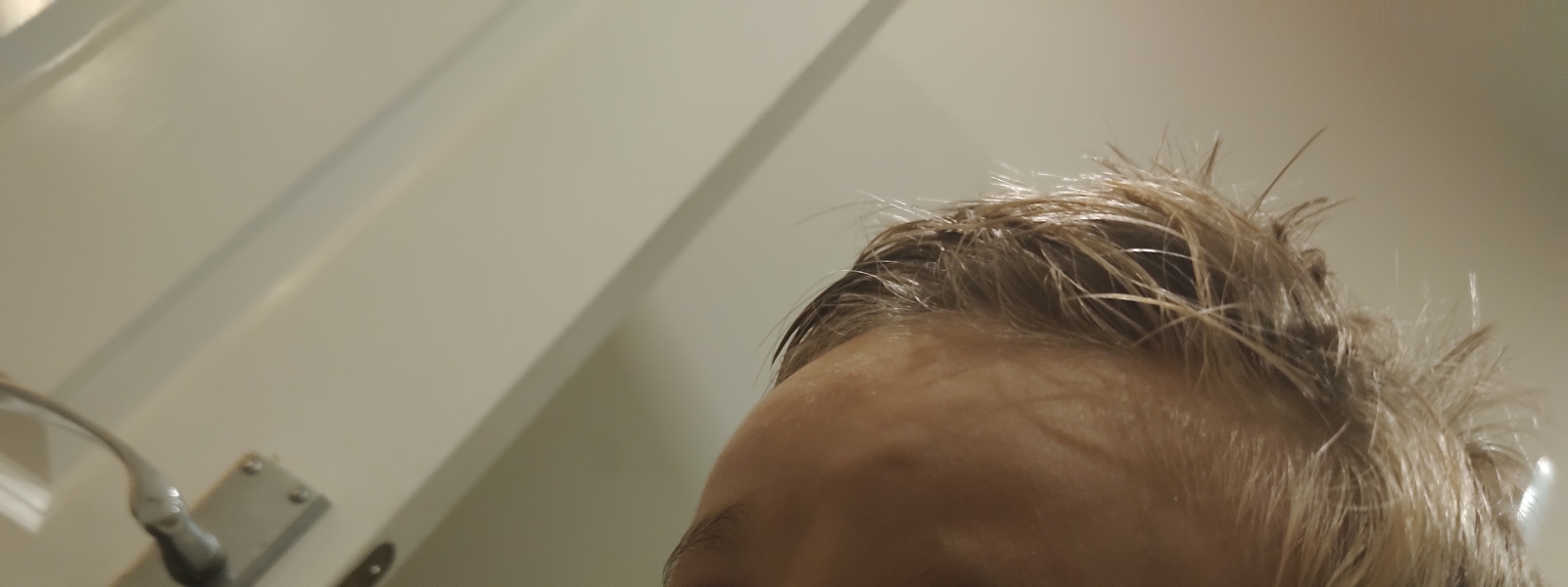 Forehead Lump - Really worried!