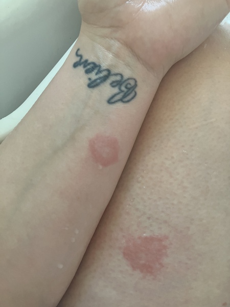 Bites/reaction