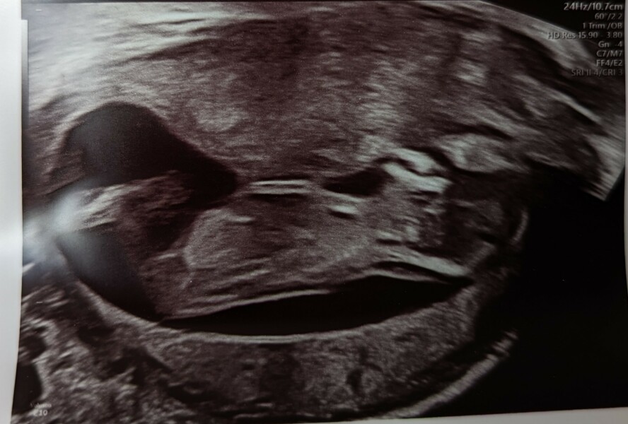 13 weeks 1 day scan