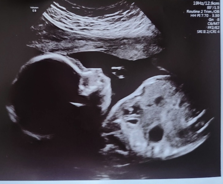 Boy or girl