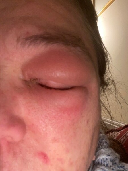 To think you don’t go to A&E for eye pain?