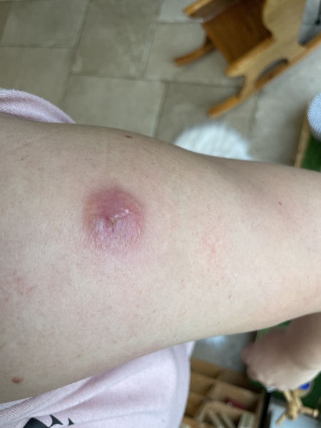 Bite has lasted for 5 weeks tw on photos