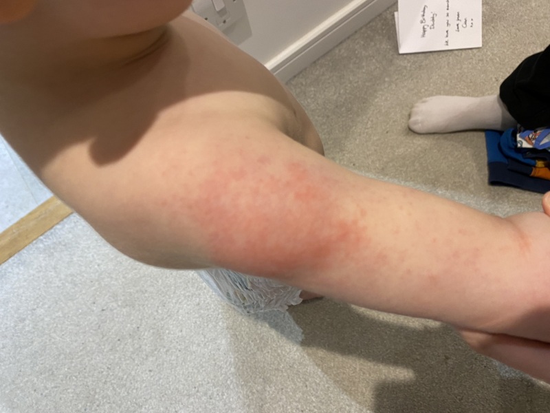 Doss this look like eczema?