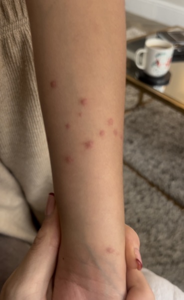 Hello what are these that have appeared on daughters arm?