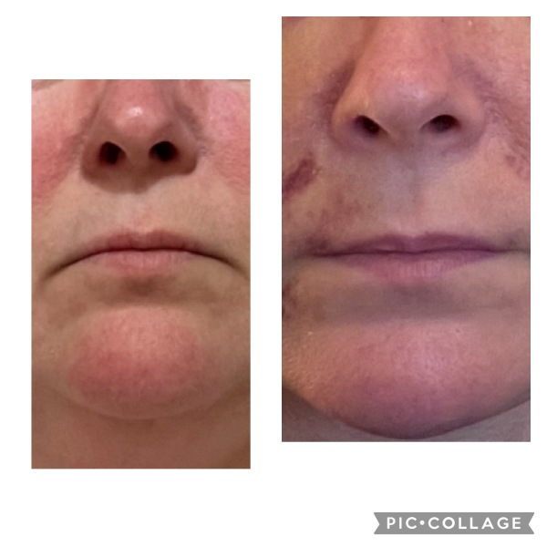 Does anyone want to come on my Upper and Lower Bleph and Necklift journey with me?