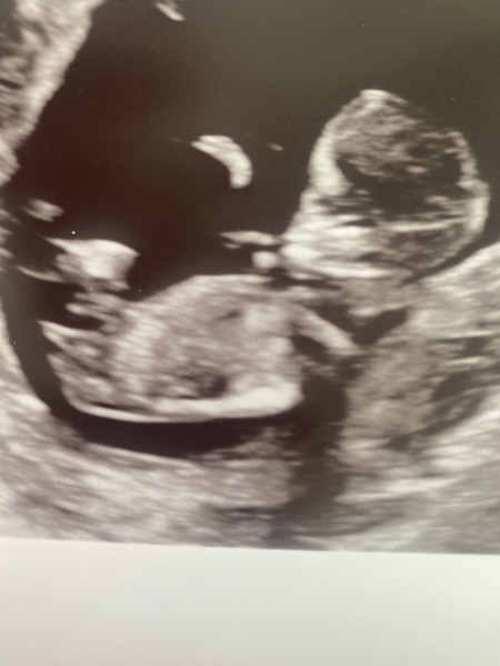 Pregnancy Scans