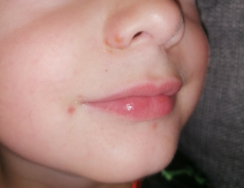Spots on toddler face?