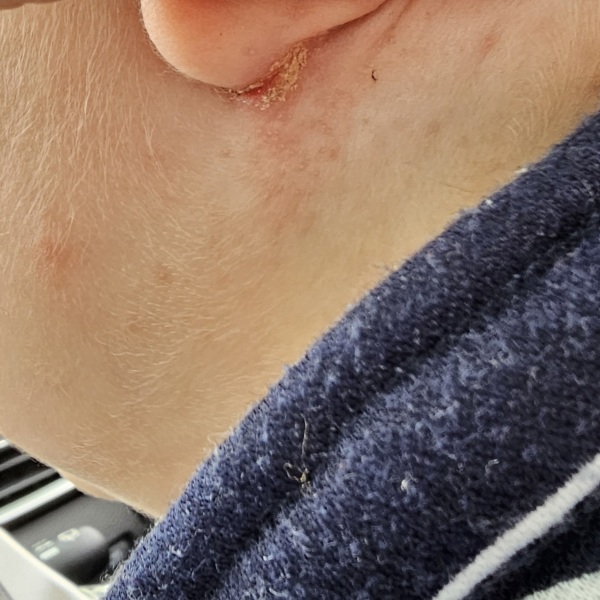 To be concerned this isn't eczema?? Help!