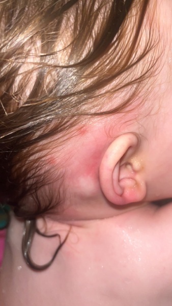 Baby rash & reaction to hydrocortisone