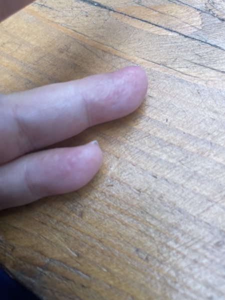 Sudden allergy to BIAB nails :(