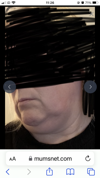Does anyone want to come on my Upper and Lower Bleph and Necklift journey with me?