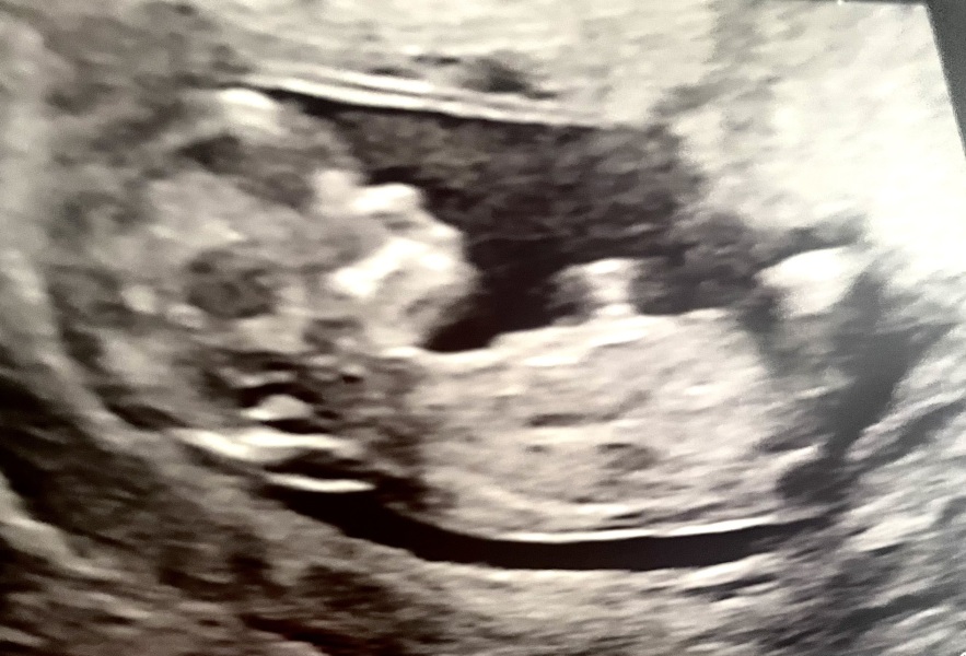 12 week scan guesses