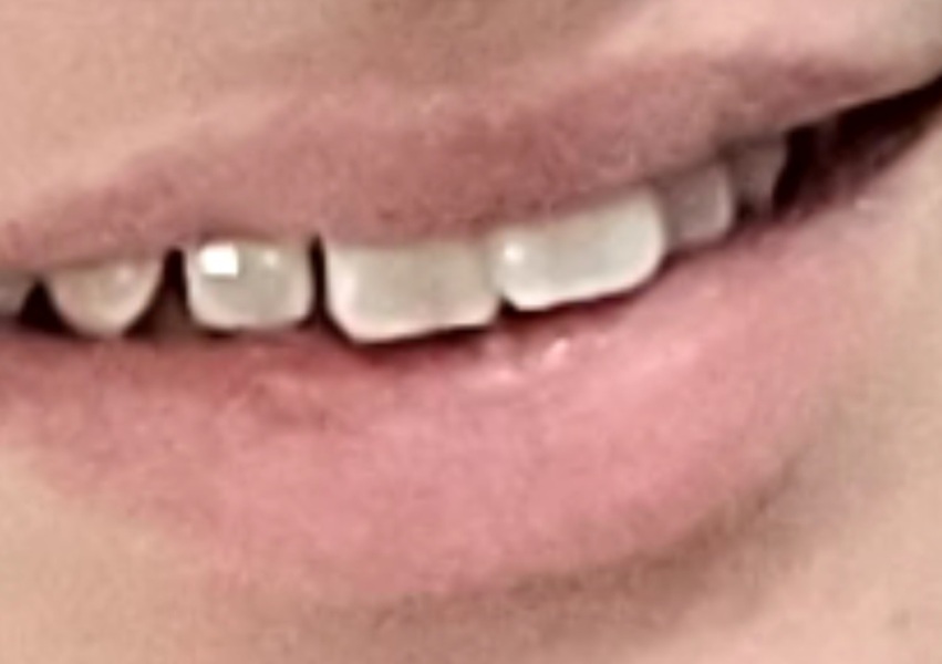 Teeth braces drama