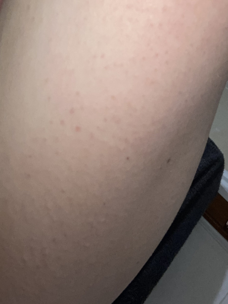 Spots or bumps on chest and arms