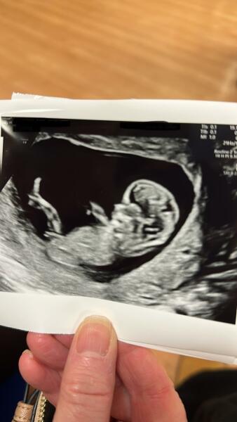 12 week scan, boy or girl?