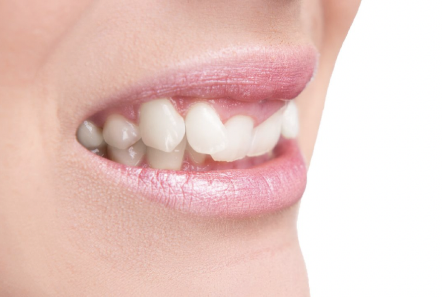 Braces/invisalign