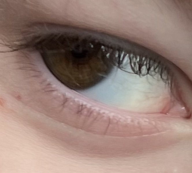 Eye issues