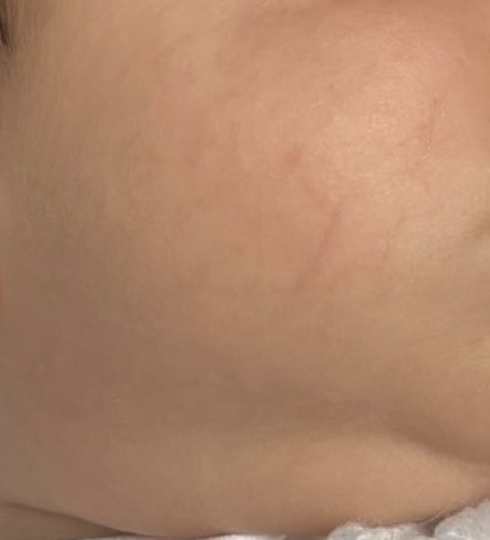 Spider Veins/Broken Capillaries on my baby’s cheek