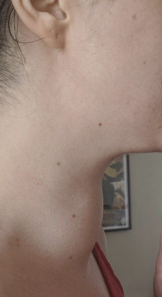 Swollen/lump in middle of neck