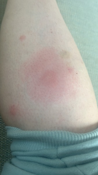 Bite on leg