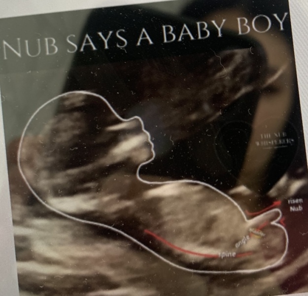 Did anyone have a boy nub on their 12 week scan but end up having a girl?