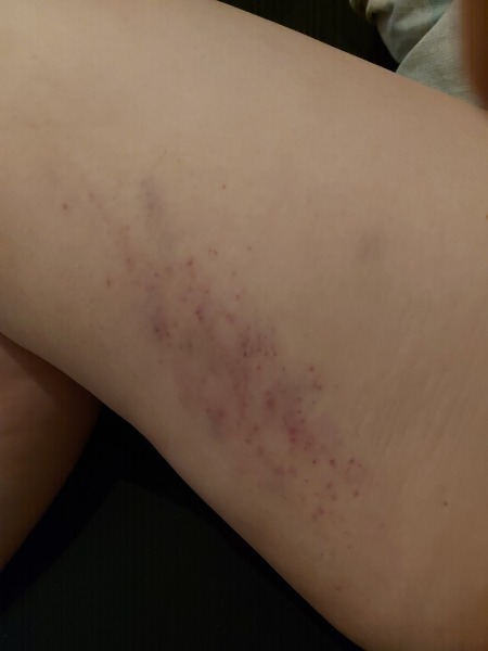 Bruising