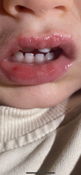 19 month old sore mouth