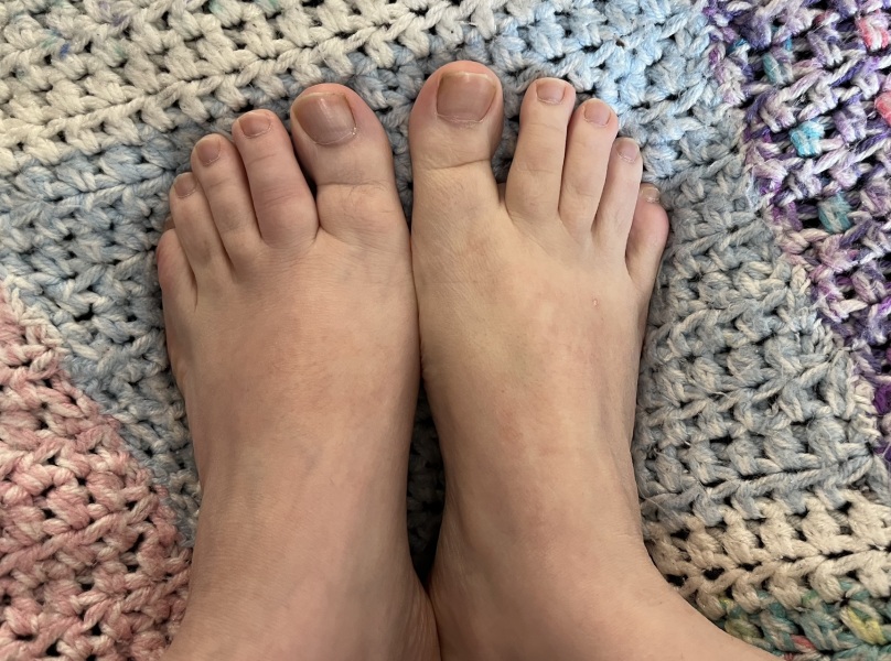 Sore second toe