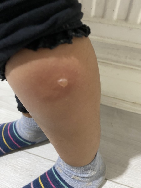Any idea what these spots on toddler could be?