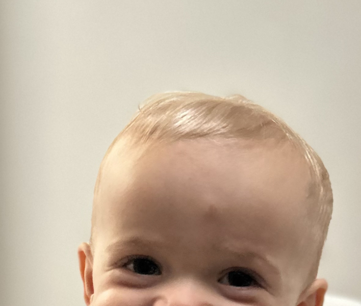 14 month old forehead injury