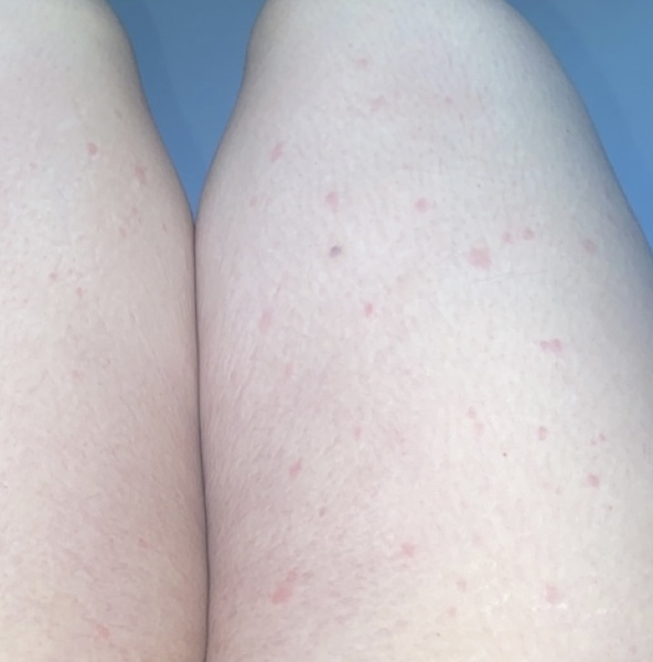 Spotty rashes all over body & flushed face picture attached