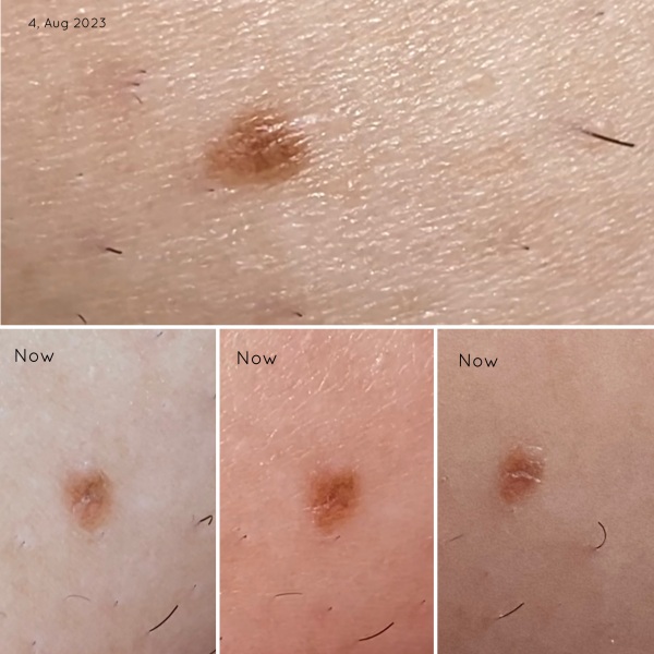 I had this spot. I don't know if it's a mole or not. I've had it for 3 years.